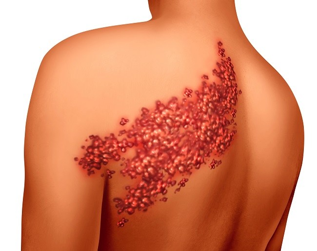 Penyakit Herpes: Gejala, Sebab, Ciri Ciri, Cara Mengatasi